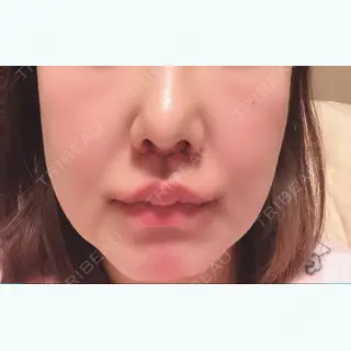 8日目の経過画像（1枚目）