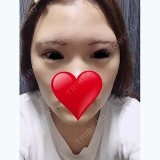 4日目の経過画像（1枚目）