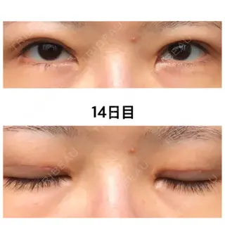 14日目の経過画像（1枚目）
