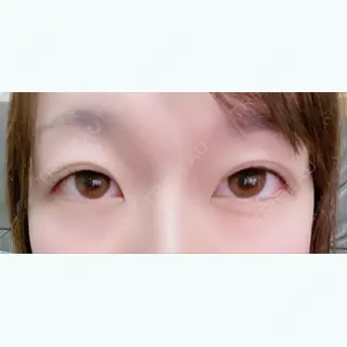 152日目の経過画像（1枚目）