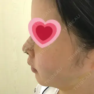 4日目の経過画像（2枚目）