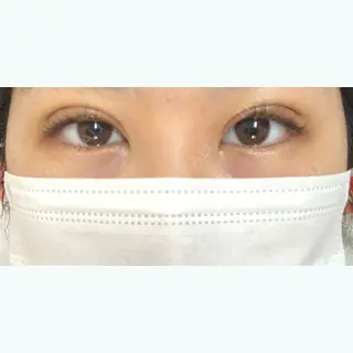 6日目の経過画像（1枚目）