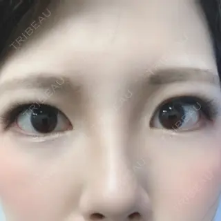 33日目の経過画像（1枚目）