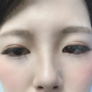 33日目の経過画像（3枚目）