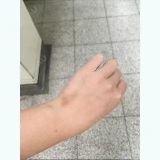 5日目の経過画像（3枚目）