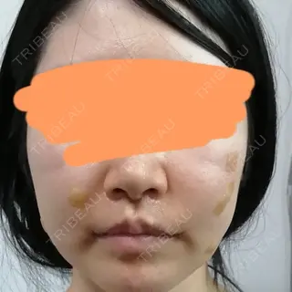5日目の経過画像（1枚目）