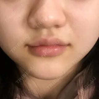1日目の経過画像（1枚目）