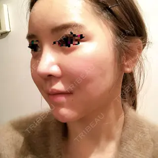 49日目の経過画像（2枚目）