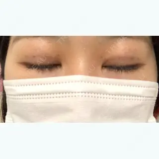9日目の経過画像（3枚目）