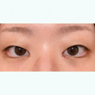 4日目の経過画像（2枚目）