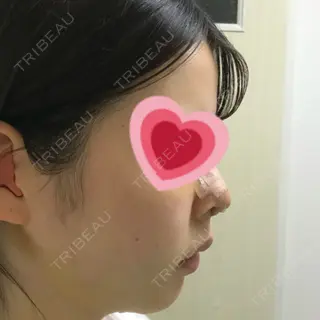 5日目の経過画像（2枚目）