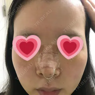 6日目の経過画像（1枚目）