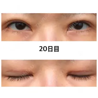 20日目の経過画像（1枚目）