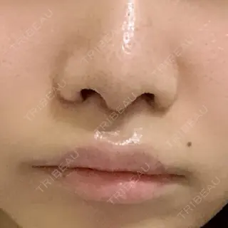 7日目の経過画像（2枚目）