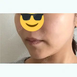 19日目の経過画像（2枚目）