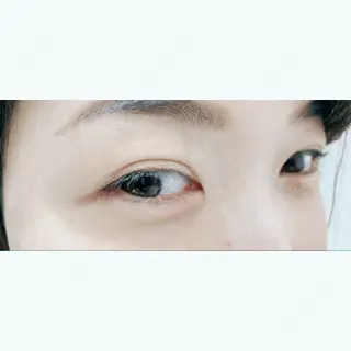 0日目の経過画像（2枚目）