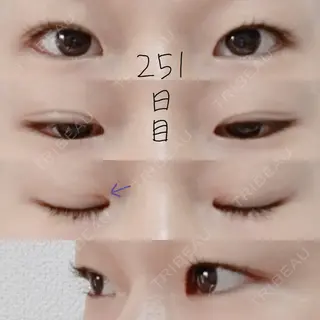 251日目の経過画像（1枚目）