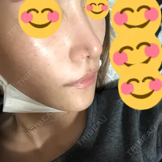 0日目の経過画像（1枚目）