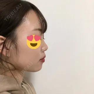 3日目の経過画像（2枚目）