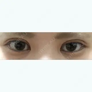 5日目の経過画像（2枚目）
