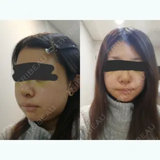4日目の経過画像（1枚目）