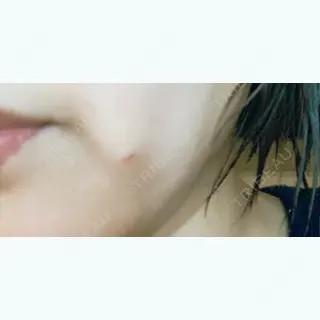 4日目の経過画像（1枚目）