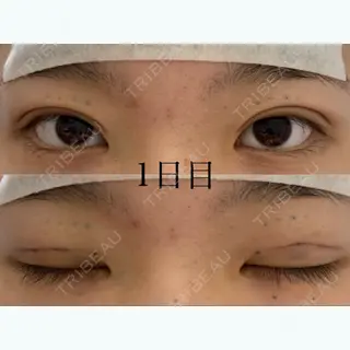1日目の経過画像（1枚目）
