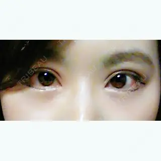 31日目の経過画像（1枚目）