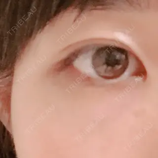 1日目の経過画像（1枚目）