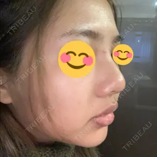 2日目の経過画像（2枚目）