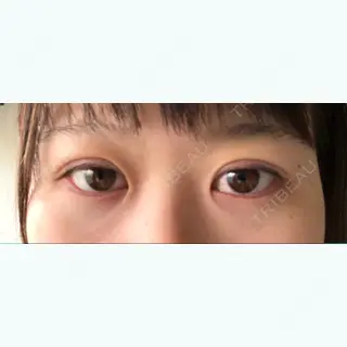 1日目の経過画像（1枚目）