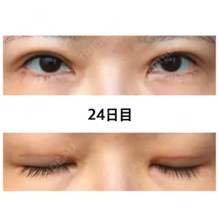 24日目の経過画像（1枚目）