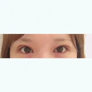 6日目の経過画像（1枚目）