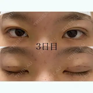 3日目の経過画像（1枚目）