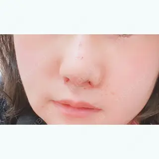 5日目の経過画像（1枚目）