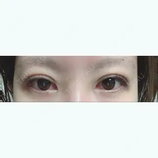 2日目の経過画像（1枚目）
