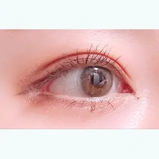 105日目の経過画像（3枚目）