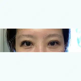 3日目の経過画像（2枚目）