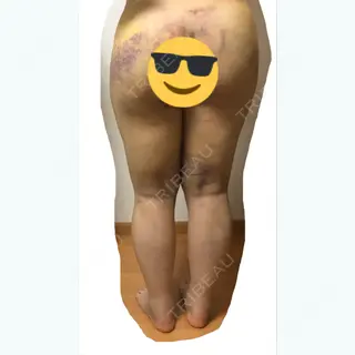 5日目の経過画像（3枚目）