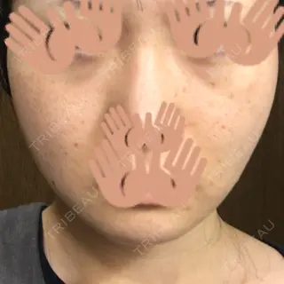 7日目の経過画像（1枚目）