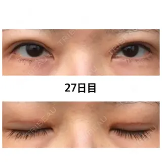 27日目の経過画像（1枚目）