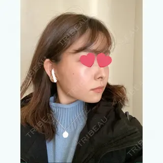 30日目の経過画像（3枚目）