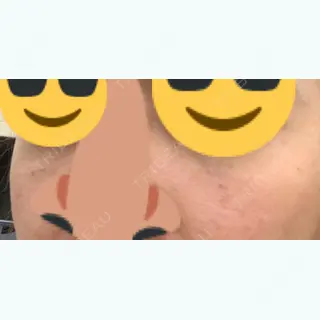 0日目の経過画像（1枚目）