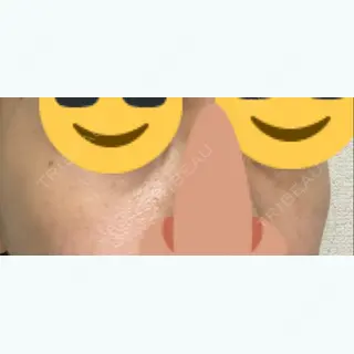 0日目の経過画像（3枚目）
