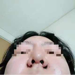 4日目の経過画像（3枚目）