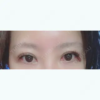 5日目の経過画像（1枚目）