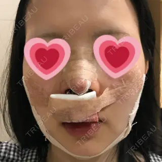 0日目の経過画像（1枚目）