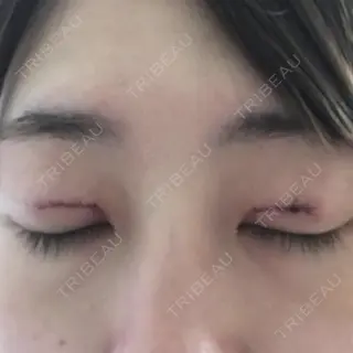 1日目の経過画像（2枚目）