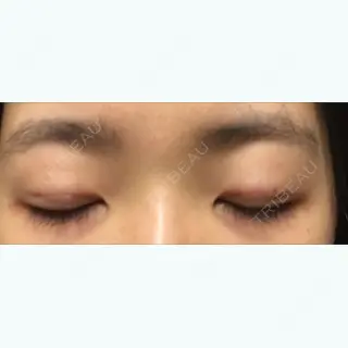 0日目の経過画像（2枚目）