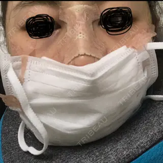 0日目の経過画像（1枚目）